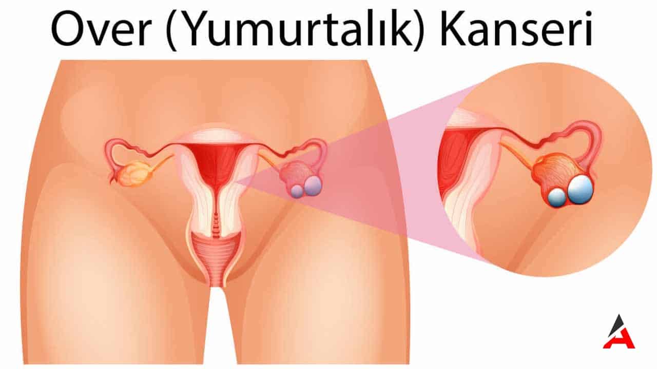 kadinlarda-yumurtalik-kanseri-22.jpg