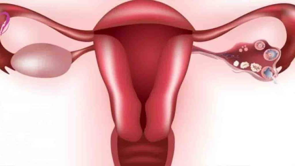 Endometriozis tedavisi ve Tedavi Seçenekleri