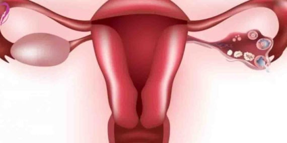 Endometriozis tedavisi ve Tedavi Seçenekleri