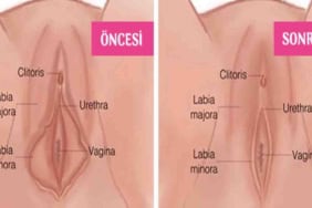 Labioplasti Nedir Kimler İçin Uygun