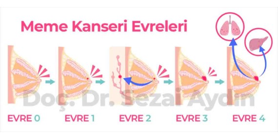 Meme Kanseri İlk Belirtileri