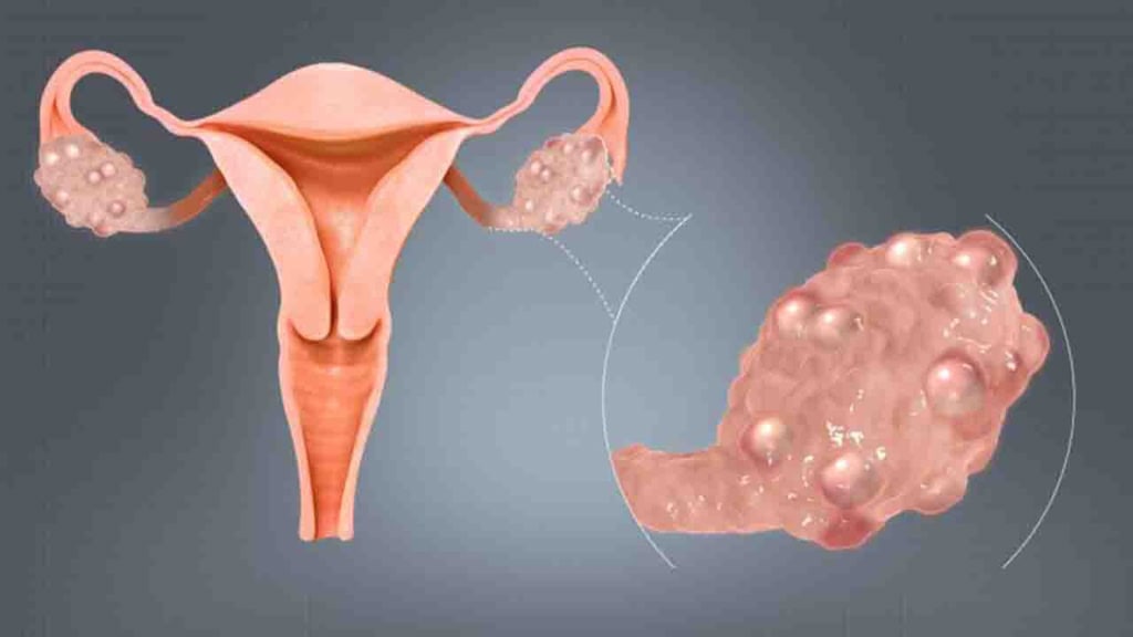 Politikistik (PCOS) Nedir